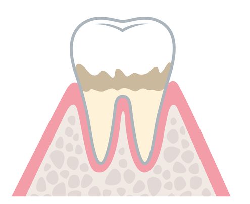 歯周病の進行