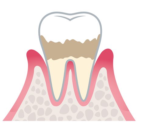 軽度歯周炎