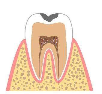C1（エナメル質のむし歯）