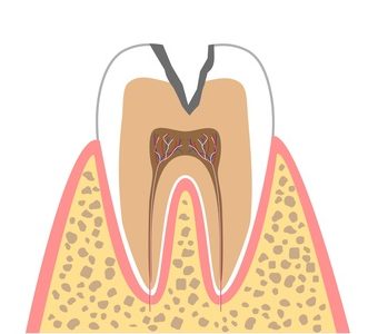 C2（象牙質のむし歯）