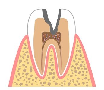 C3（歯髄まで進行したむし歯）
